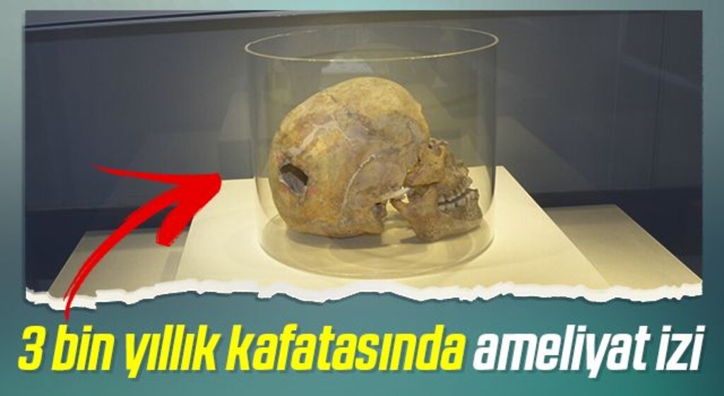 3 bin yıllık kafatasında ameliyat izi