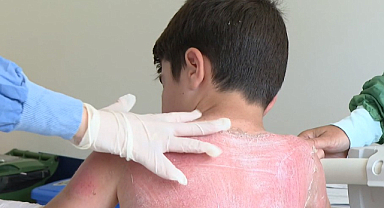 Samsun'da Tatili Kabusa Dönüştü: Çocuk İki derece Yanıkla Hastanelik Oldu