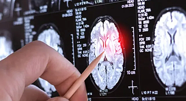 Yeni ve Çok Nadir Nörolojik Hastalık Keşfedildi