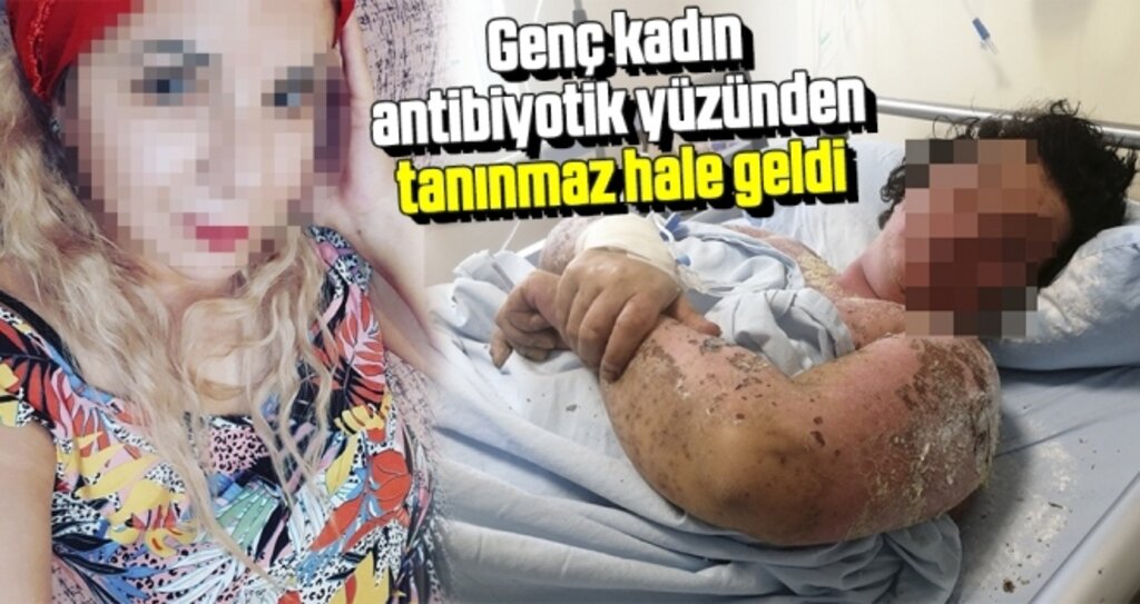 Genç kadın antibiyotik yüzünden tanınmaz hale geldi