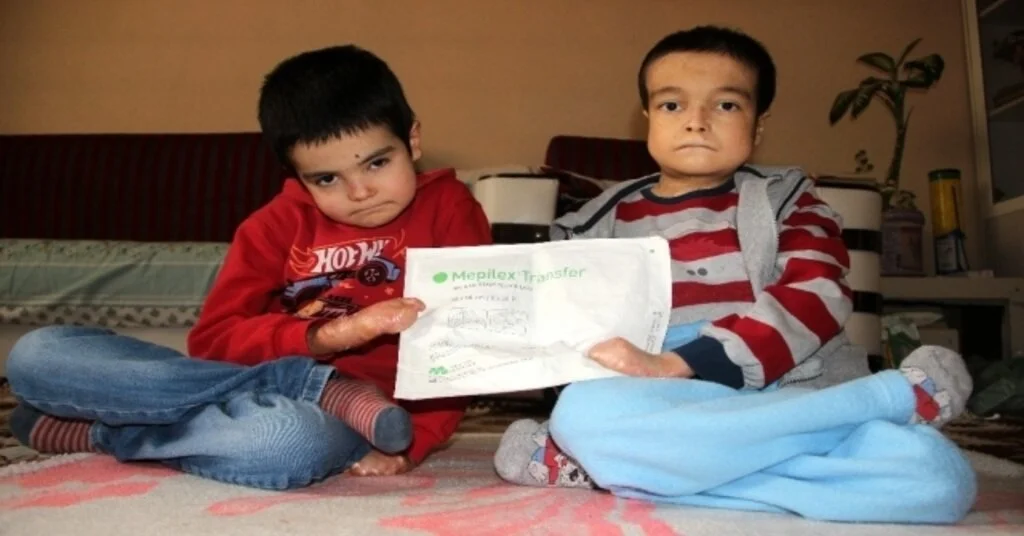 (Özel) Kelebek Hastası Kardeşlerin Yürek Burkan Mücadelesi