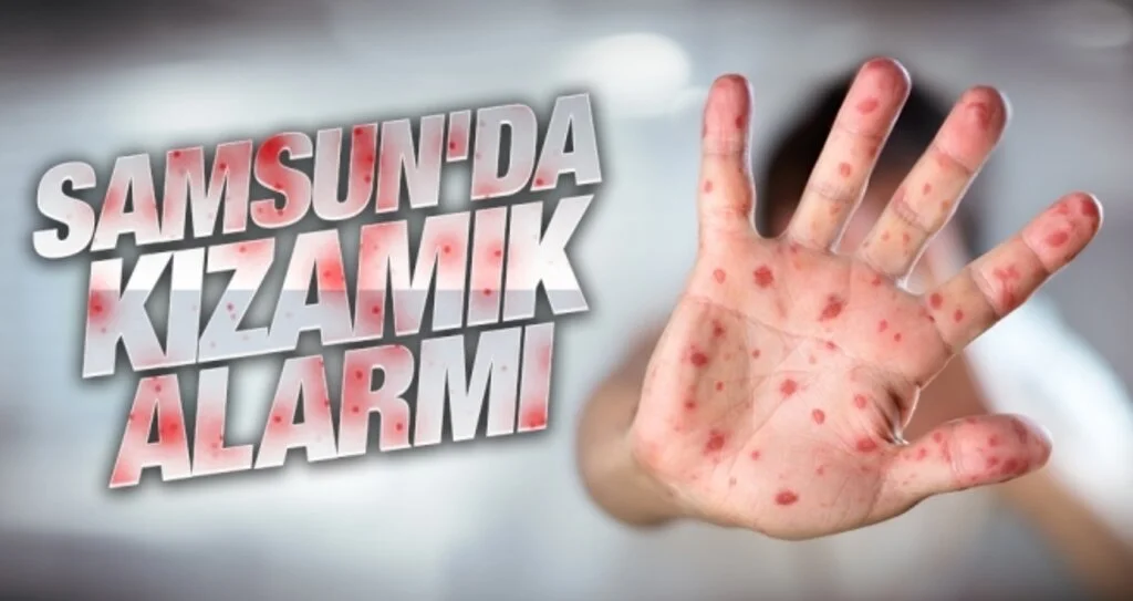 Samsun'da kızamık alarmı 