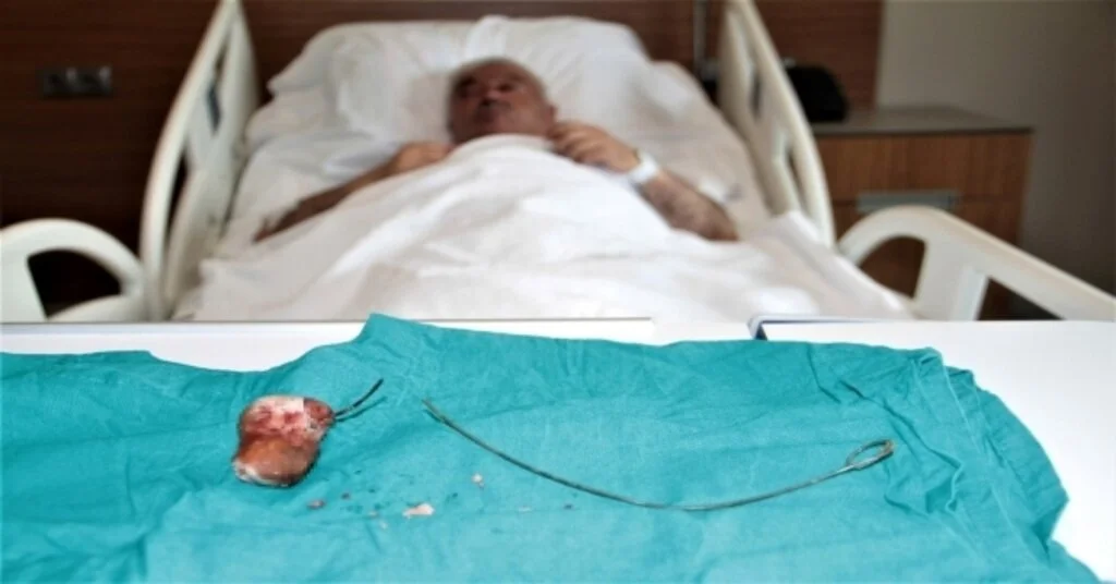 Unutulan 28 Santimlik Stent 7 Yıl Sonra Fark Edildi