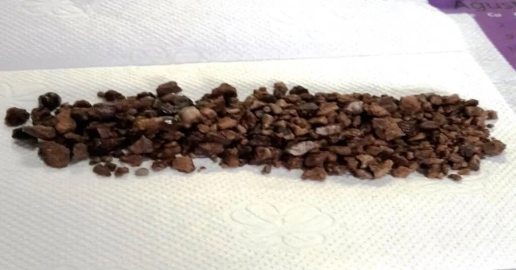 Böbreklerinde 500 Adet Taş Çıktı