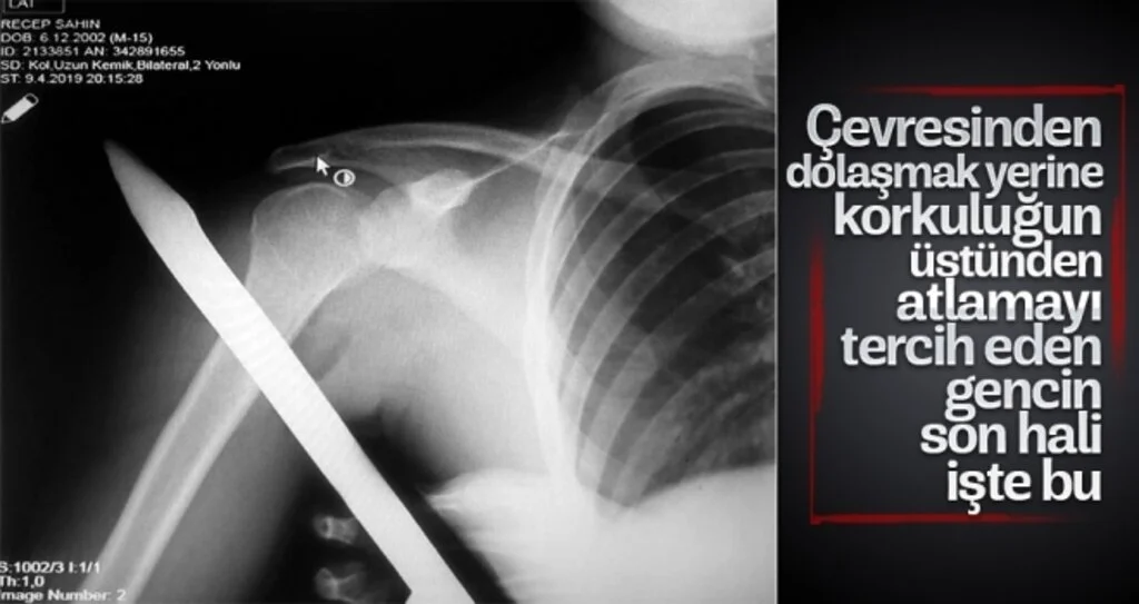 Samsun'da Feci Olay! Omzuna korkuluk demiri saplandı