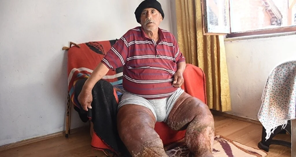 Fil hastası adam  yardım bekliyor 