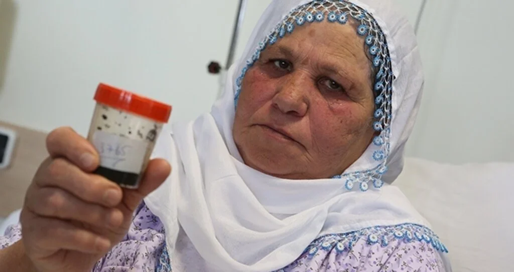 Safra kesesinden 3  bin 765 taş çıkarıldı