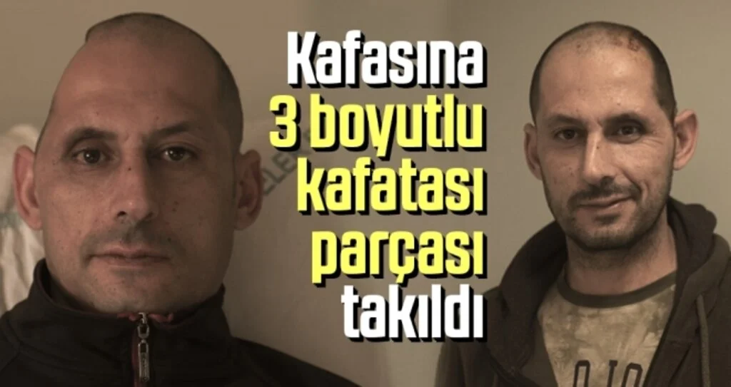 Kafasına 3 Boyutlu Kafatası Parçası Takıldı