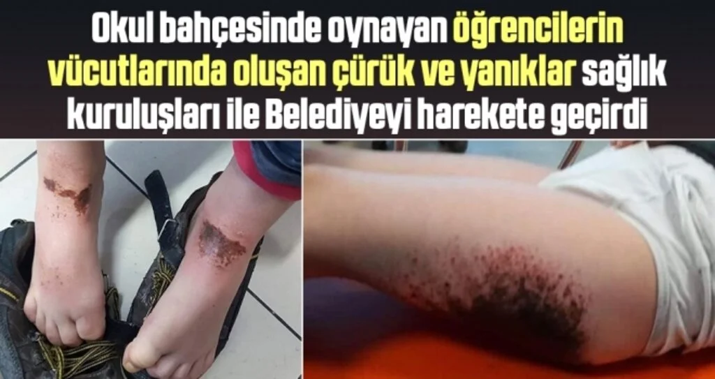 Okul bahçesinde oynayan öğrencilerin vücutlarında oluşan çürük ve yanıklar sağlık kuruluşları ile Belediyeyi harekete geçirdi