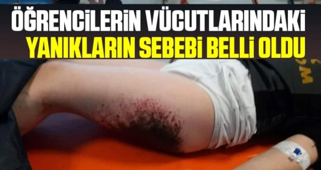 Öğrencilerin Vücutlarındaki Yanıkların Sebebi Belli Oldu