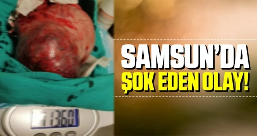 Samsun'da Hamile Sanılan Kadının Karnından 11 Kilo Ur Çıktı!