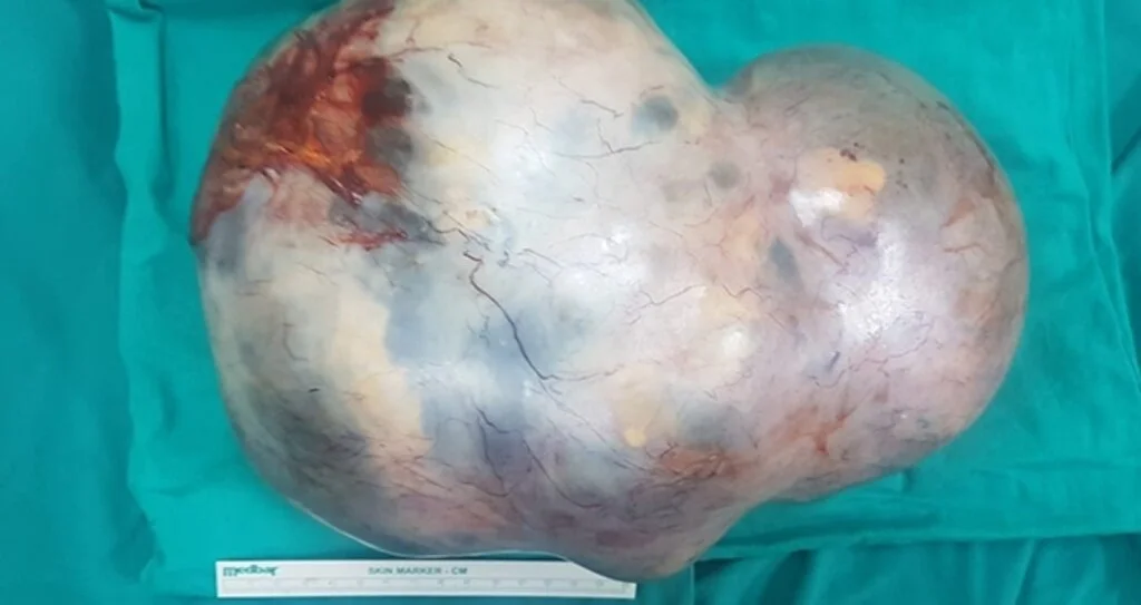17 yaşındaki kızın karnından 5 kiloluk tümör çıktı, doktor gözlerine inanamadı