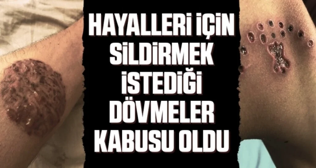 Hayalleri için sildirmek istediği dövmeler kabusu oldu