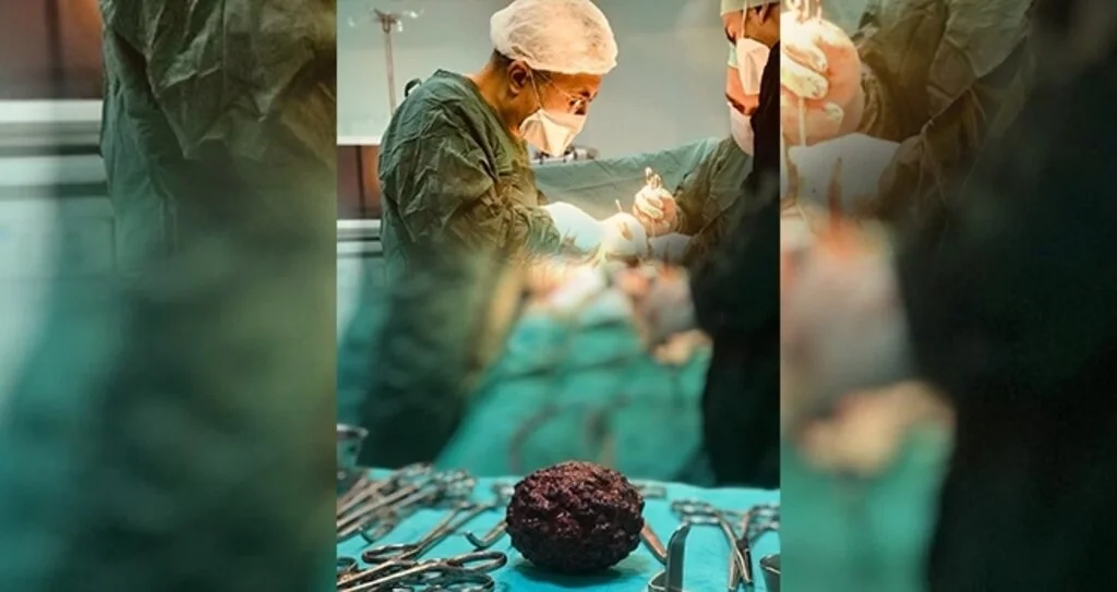 Mesaneden 8 cm’lik 'dev taş' çıkarıldı