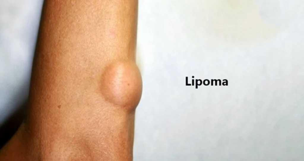 Lipoma Tedavisi