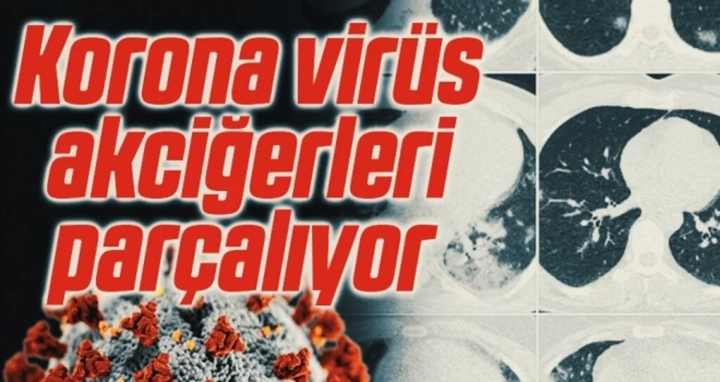 Özkaya: Korona virüs akciğerleri parçalıyor 