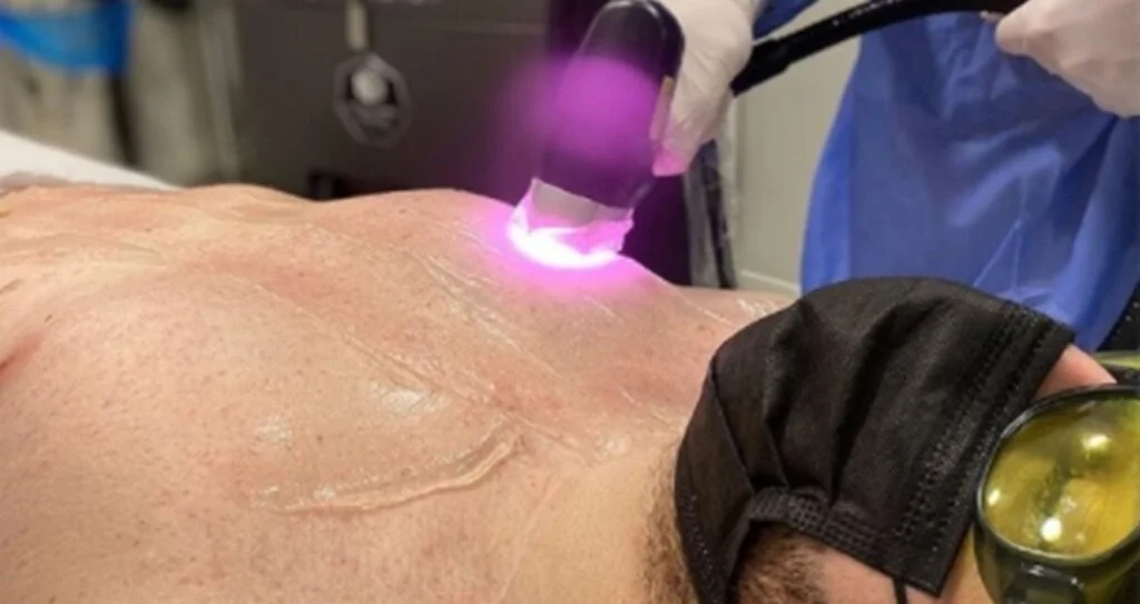 Erkek lazer epilasyon da ağrısız acısız lazer epilasyonun tadını titanyum buz lazer ile çıkarın