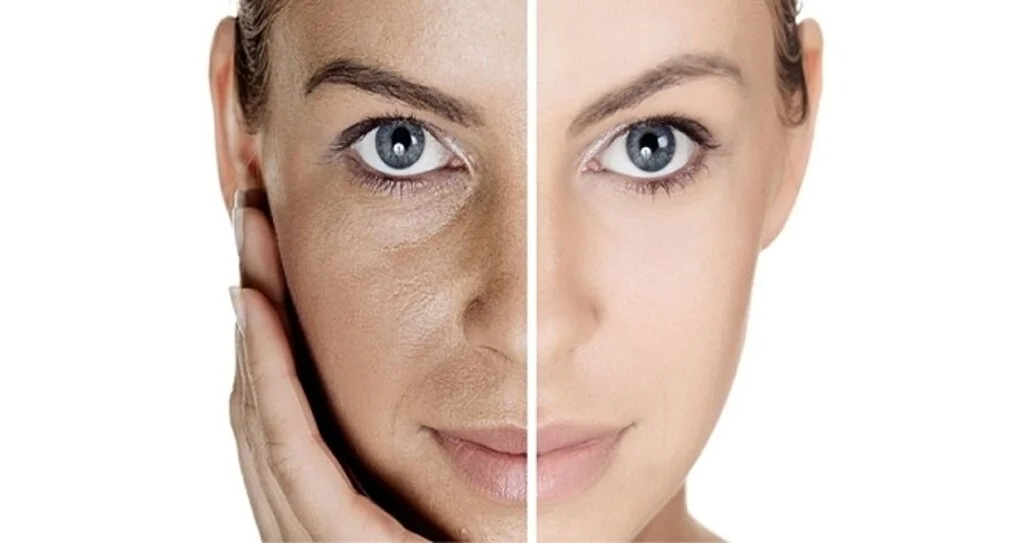 Karbon peeling nedir?