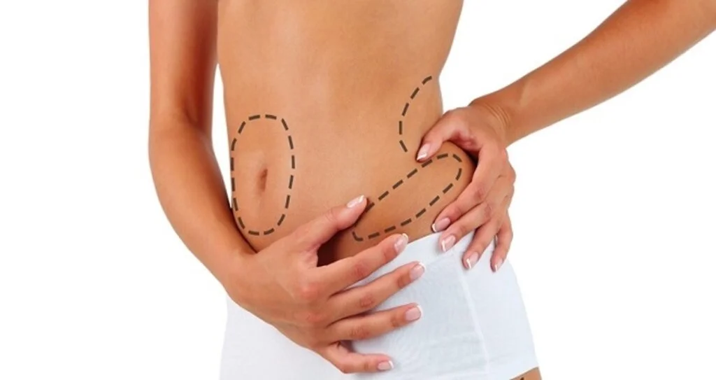 Liposuction Nedir ve Nasıl Yapılır?