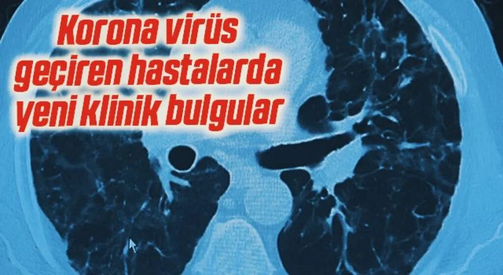 Korona virüs geçiren hastalarda yeni klinik bulgular: "Uzamış Covid ve post Covid"