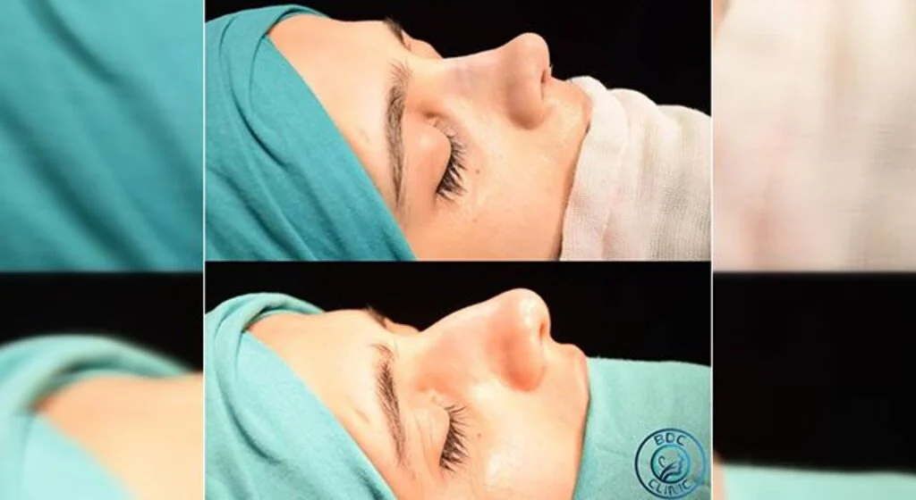 Clinic BDC İle Burun Sorunundan Kurtulun
