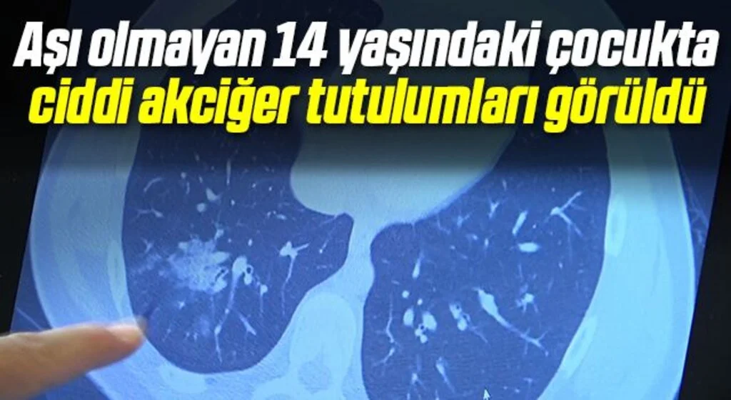 Aşı olmayan 14 yaşındaki çocukta ciddi akciğer tutulumları görüldü