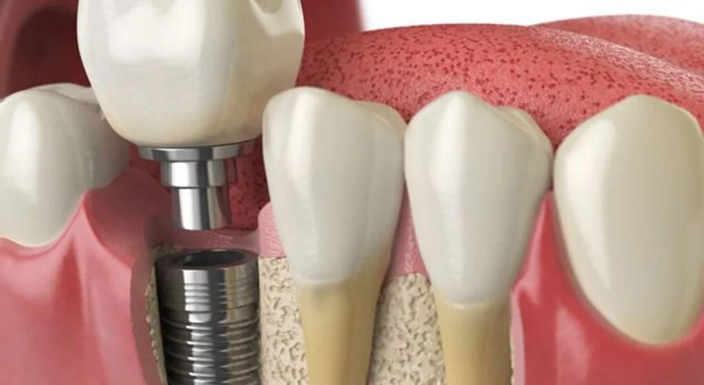 Implant Nedir?