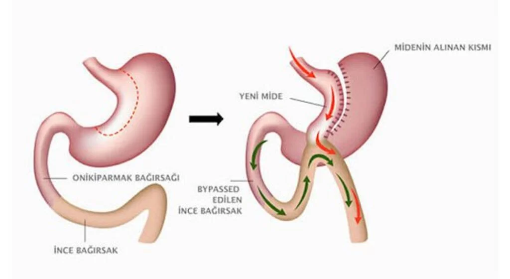 Şeker Ameliyatı Nedir?