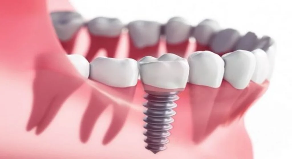 Ağız ve diş sağlığınız için implantın önemi