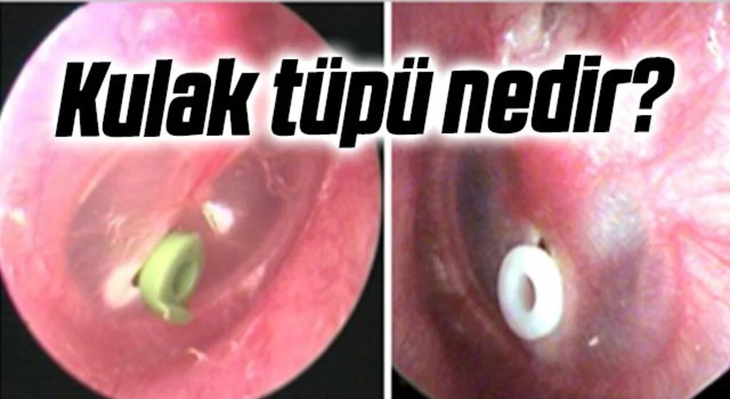 Kulak tüpü nedir?