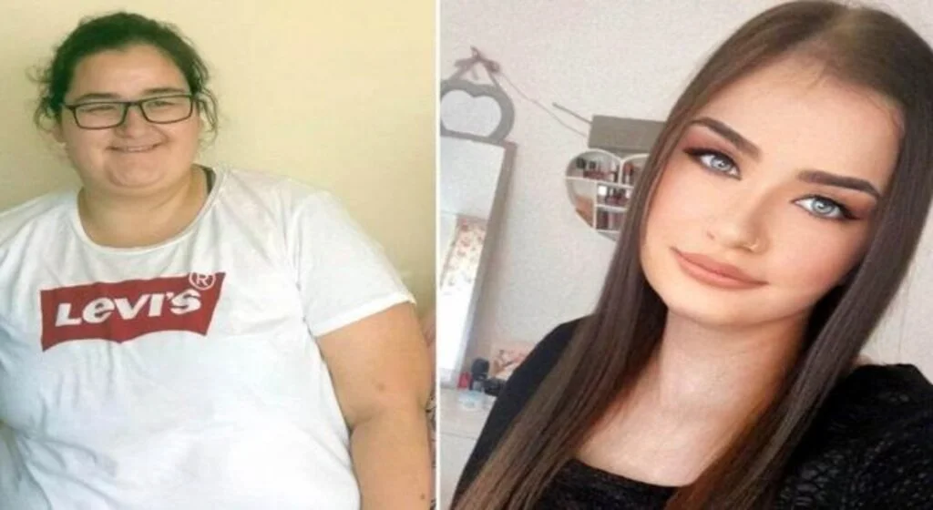 Mide baypass ameliyatı oldu, 177 kilodan 59 kiloya düştü
