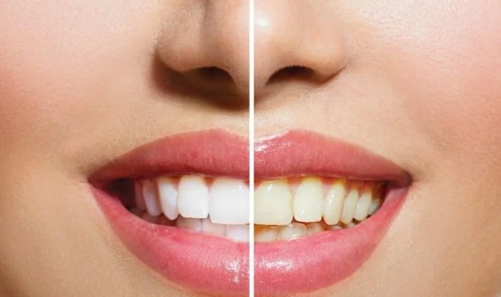 Diş beyazlatma (bleaching) işlemi nedir ?