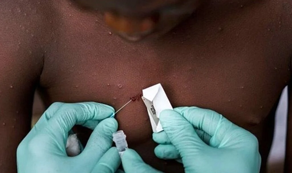 Maymun Çiçeği virüsü nedir, belirtileri nelerdir? Monkeypox - Maymun Çiçeği Türkiye'de var mı?