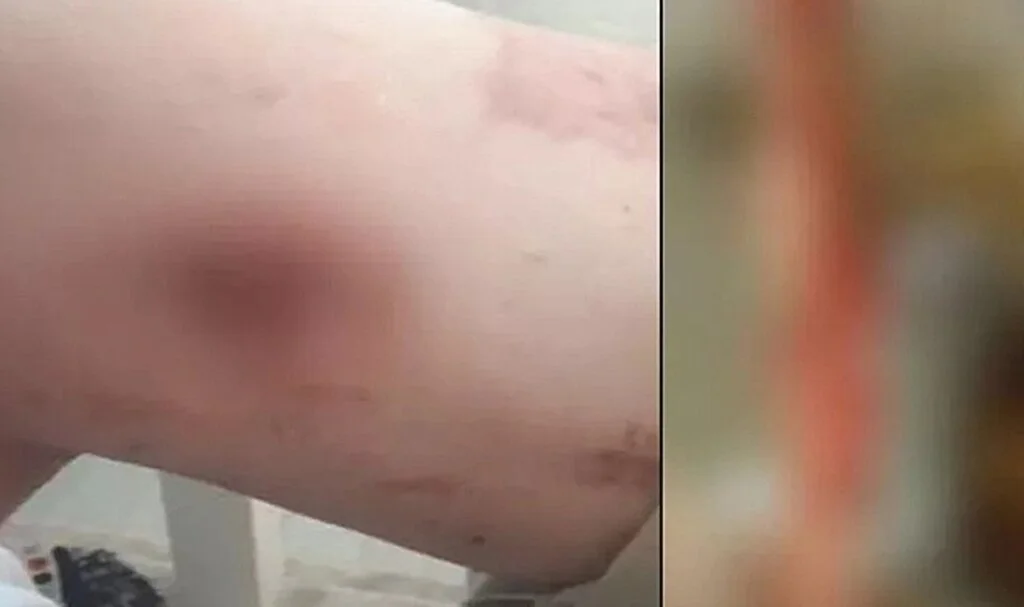Ameliyat sırasında bacağında 1,5 metrelik sargı bezi unuttular! Cımbızla çekmeye başladı, gördüklerine inanamadı