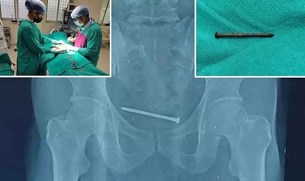 Doktorlar afalladı! 10 cm’lik paslı çivi çıktı