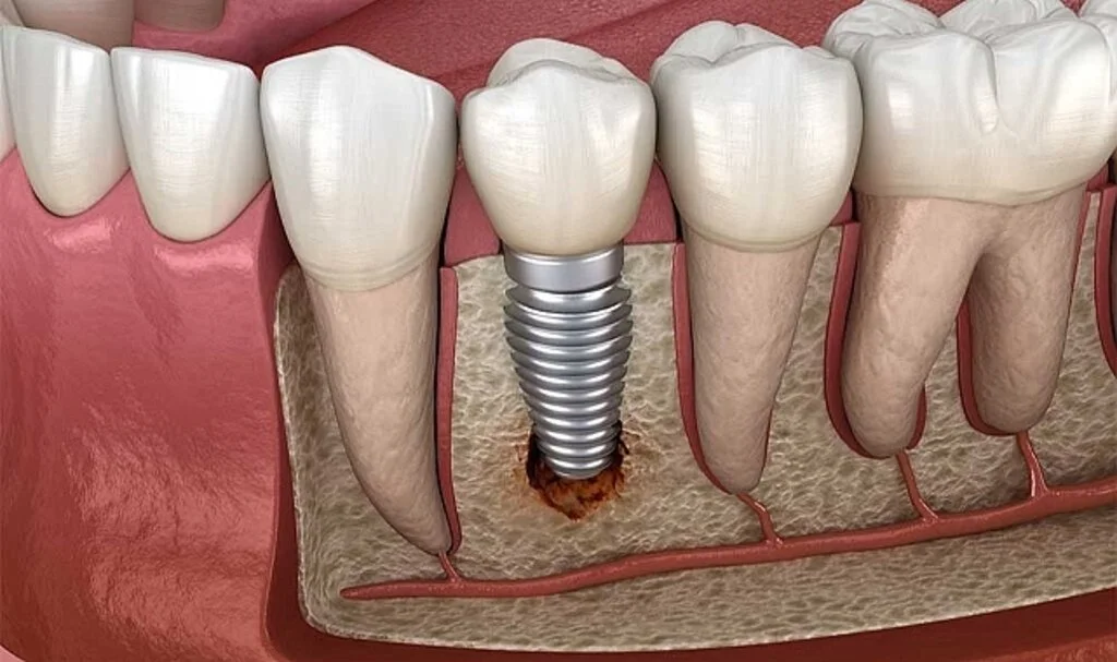 İmplant Diş Tedavisi Nedir?