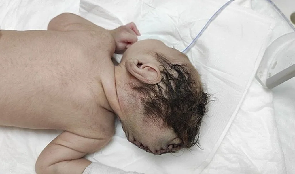 Kahramanmaraş’taki bebek beyninin yarısı kafatası dışında dünyaya geldi