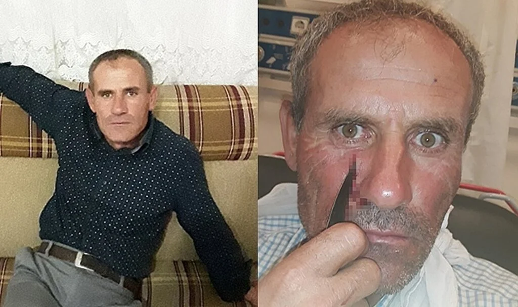 Yüzüne saplanan bıçakla hastaneye kaldırıldı