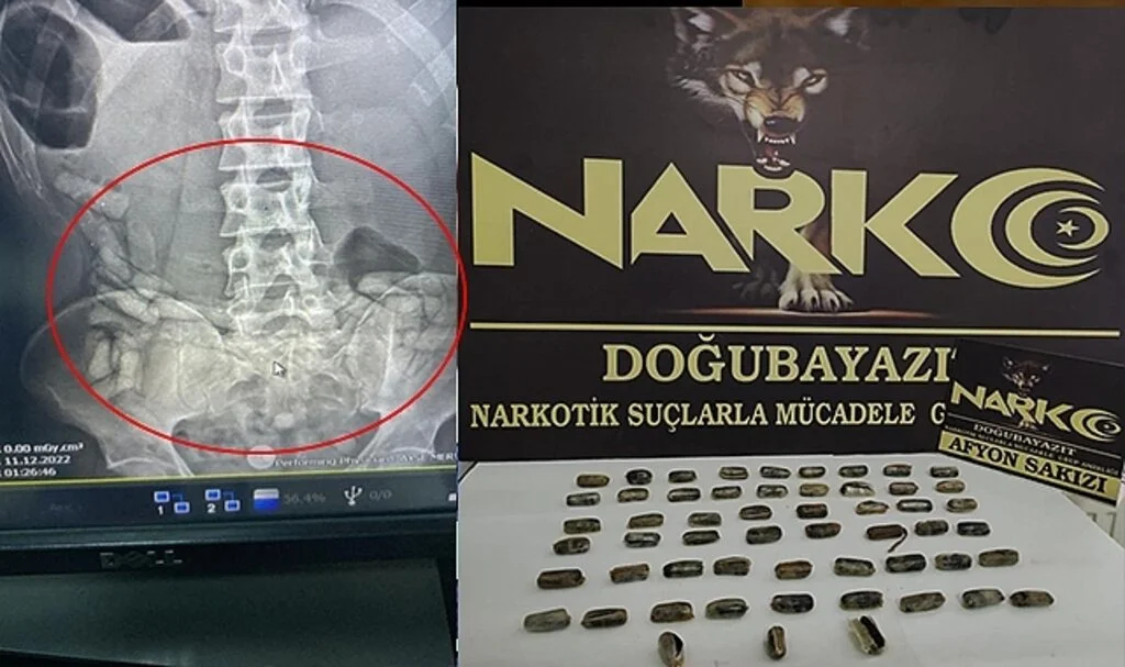 İran Uyruklu Şahsın Midesinden 55 Kapsül Afyon Sakızı Ele Geçirildi