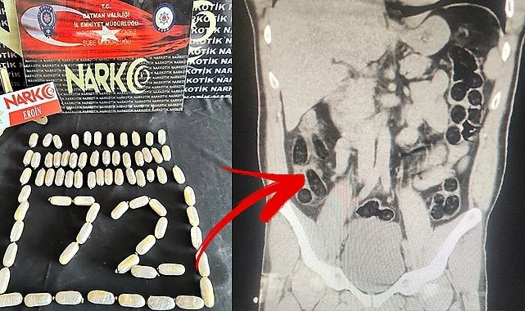 Batman’da Bir Kişinin Midesinden 714 Gram Eroin Çıktı