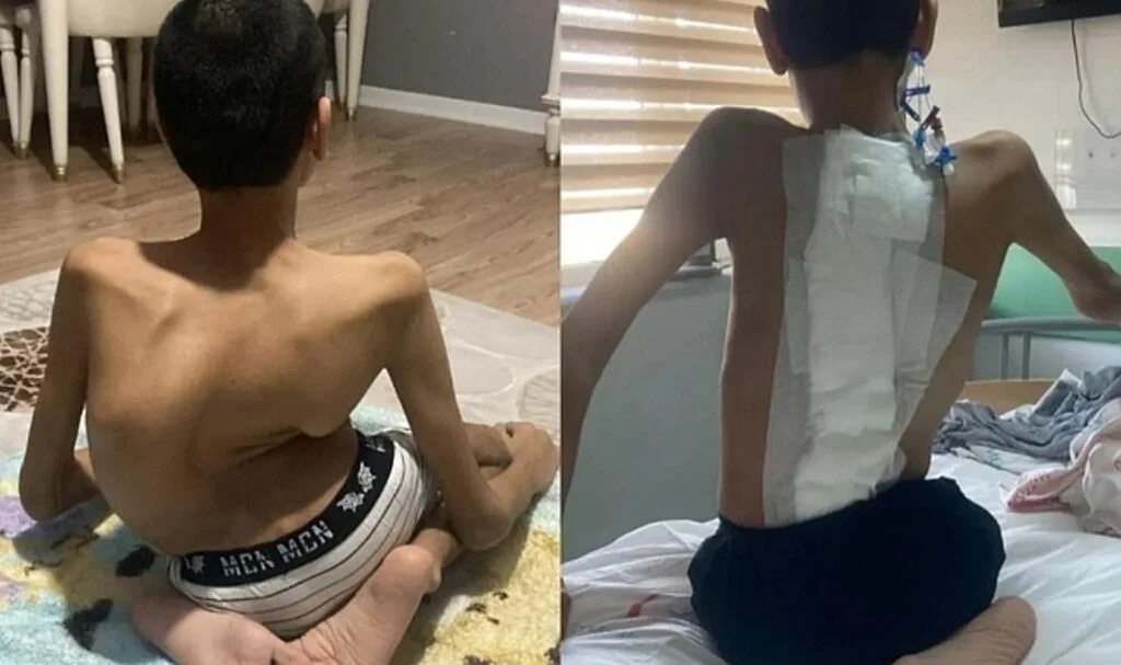 Samsun'da İleri Derecede Skolyozu Olan Çocuk, 9 Saatlik Operasyonla Sağlığına Kavuştu