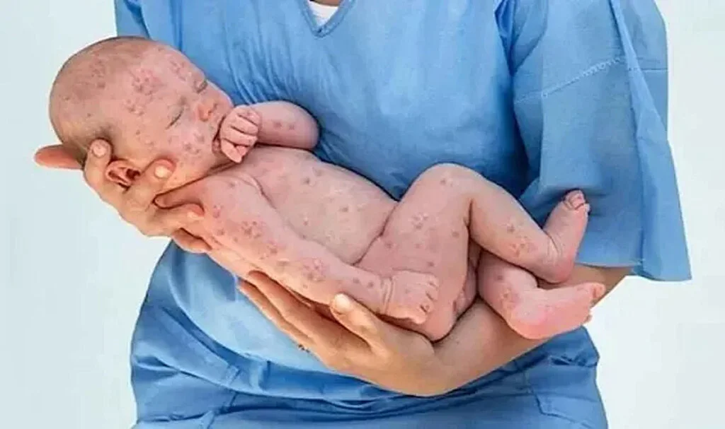 Kızamık Salgını İçin Bir Tek Bakanlık Suskun