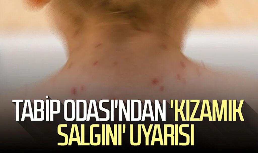 Samsun Tabip Odası'ndan 'kızamık salgını' uyarısı 