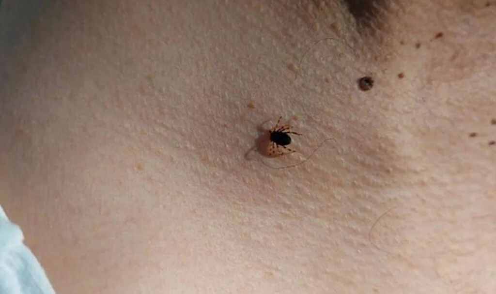 Piknik Sonrası Kene Kontrolü Uyarısı!