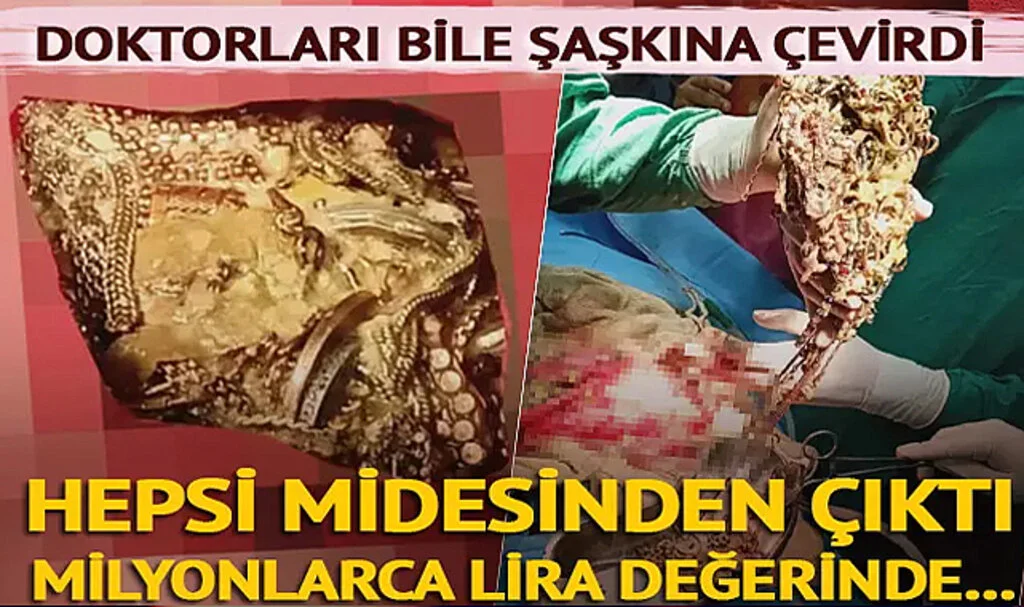 Doktorları Bile Şaşkına Çevirdi! Midesinden Mücevher ve Madeni Para Çıktı... Değeri Dudak Uçuklattı