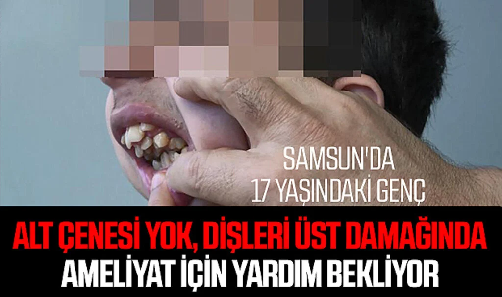 Samsun'da 17 Yaşındaki Genç; Alt çenesi yok, dişleri üst damağında: Ameliyat için yardım bekliyor