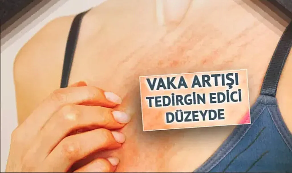 Türkiye'de salgın böyle yayılıyor! Vakalar patladı: "Utanıp söyleyemiyorlar, 5-6 ay kurtulamayan aileler var"