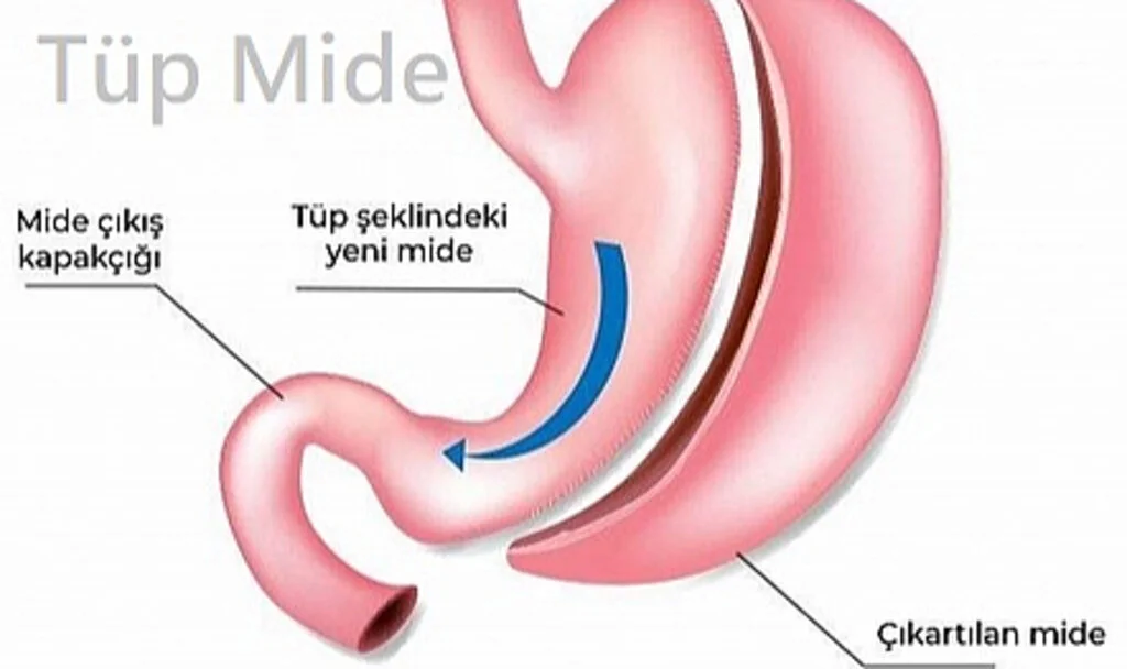Tüp mide ameliyatı fiyatları 2024