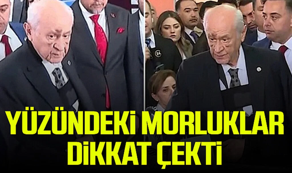 Devlet Bahçeli'nin Oyunu Kullandığı Ankara'da Yüzündeki Morluk ve Şişlikler Dikkat Çekti