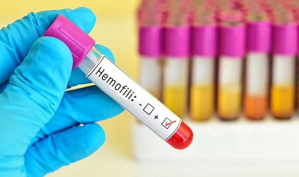 Dünya Hemofili Günü: Hemofili Nedir ve Nasıl Tedavi Edilir?